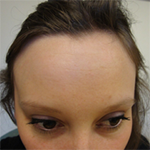 Forehead